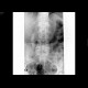 Cholecystolithiasis, gall stones: X-ray - Plain radiograph